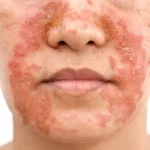 dermatite séborrhéique