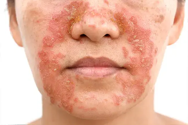 Traitement de la dermatite séborrhéique : comprendre, soigner et prévenir