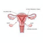 grossesse extra-utérine