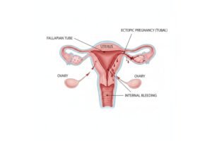 grossesse extra-utérine